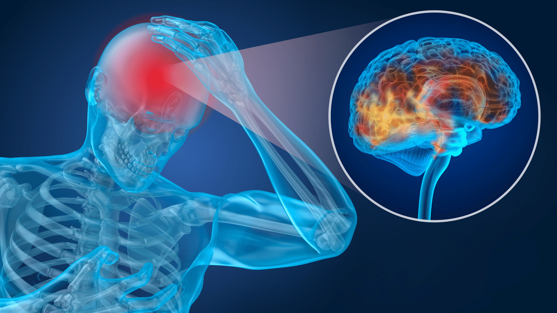 image of x-ray skeleton showing concussed brain